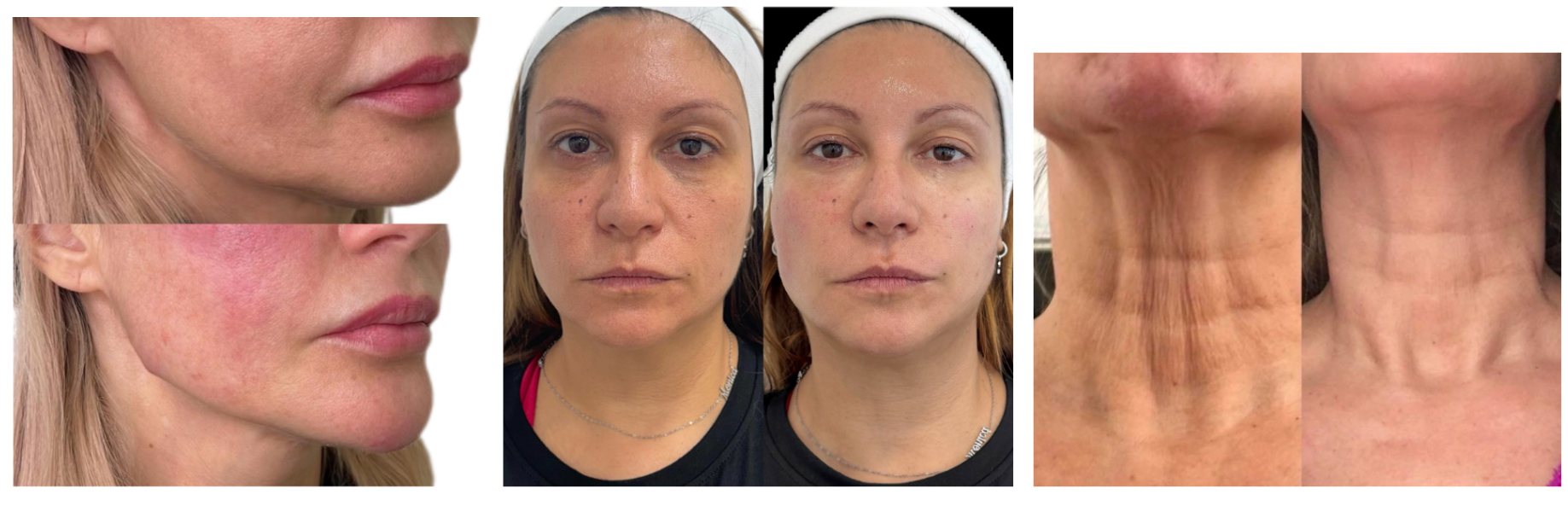 collagen ozempic face